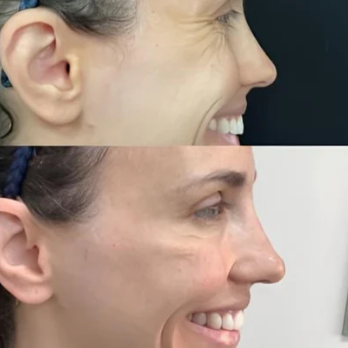 Silicone Scar & Wrinkle Solution Stick